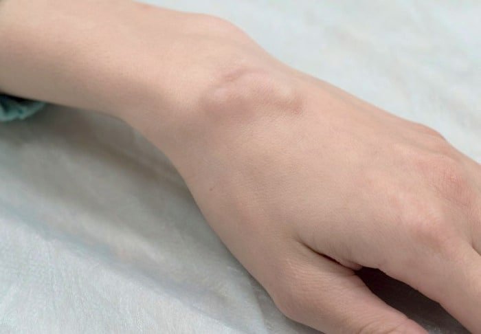 Ginger for Natural Treatment of Bursitis