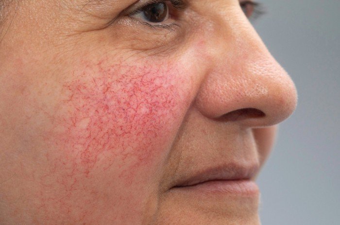 Spider veins are signs of liver disease on the skin