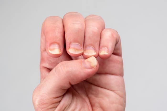 Yellowing Nails