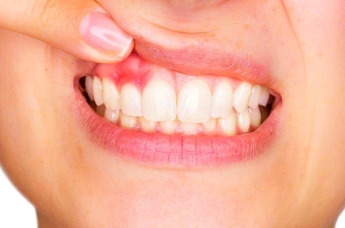 Symptoms of Peri-implantitis