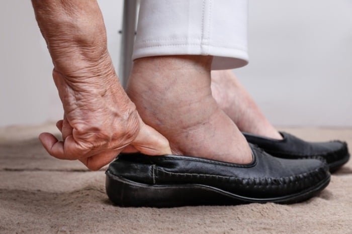 Osteoporosis is among the causes of leg swelling