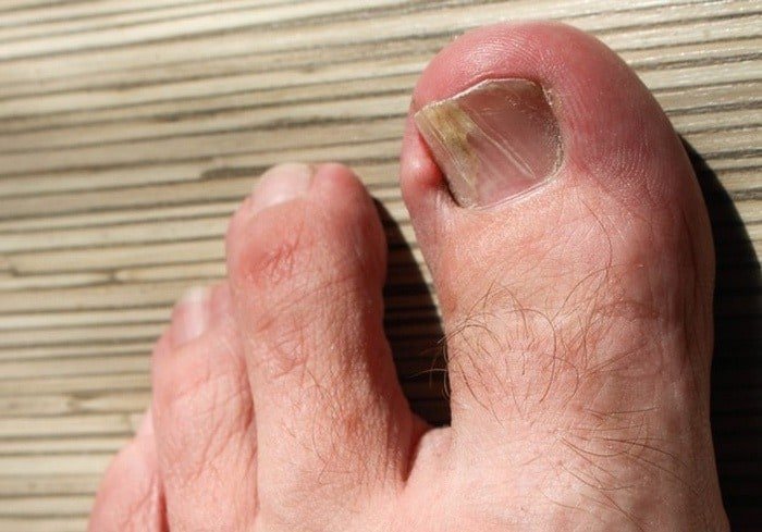 Symptoms of Nail Yellowing
