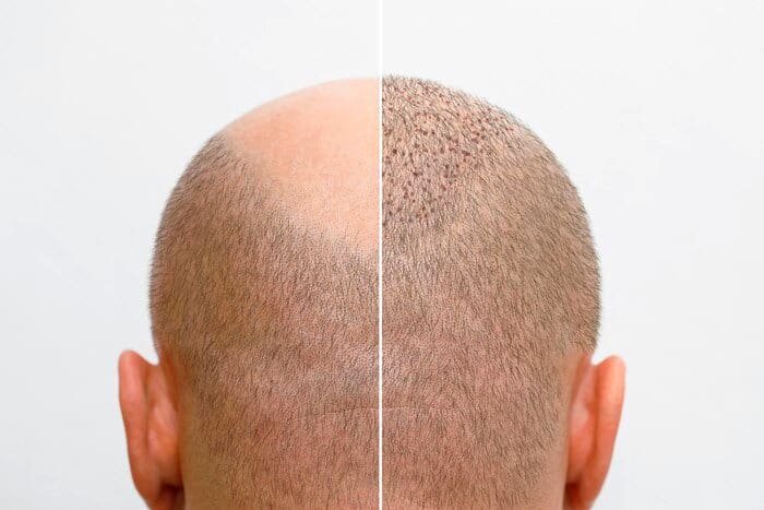 💥 Hair Loss Treatment! | You are one step away from your hair regrowth!