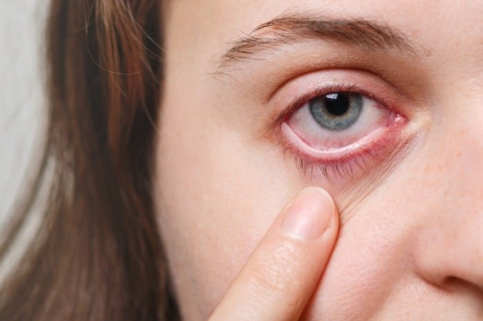 Impact to the Eye