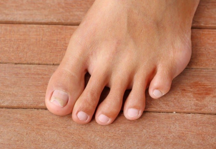 Yellowing of Fingernails