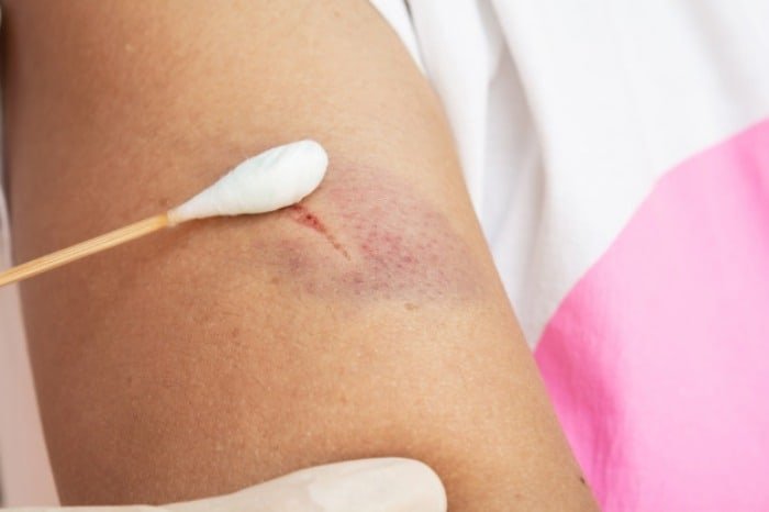 Nutrition for wound healing.