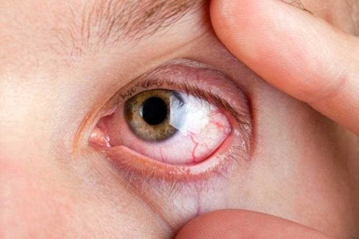 RP Disease