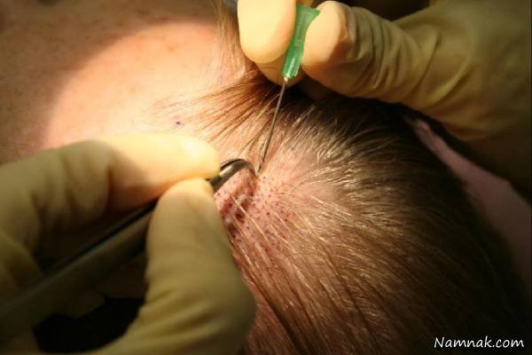 Costs of Hair Transplant Methods Scalp Hair Transplantation