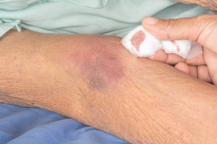 Benefits of Witch Hazel