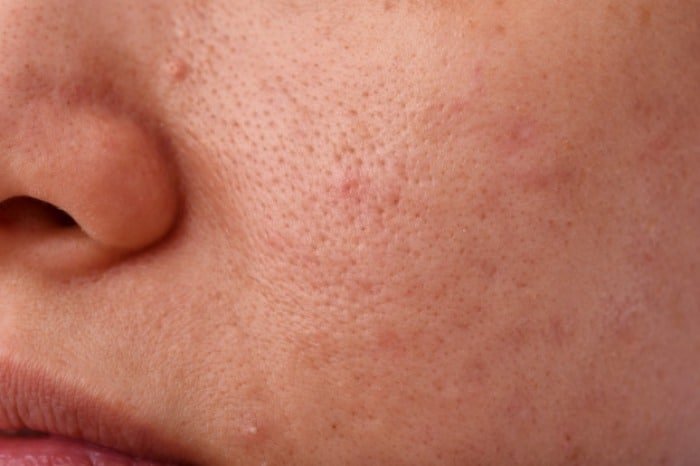 Skin sensitivity