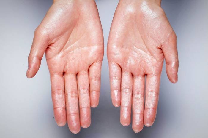 Treating Hyperthyroidism