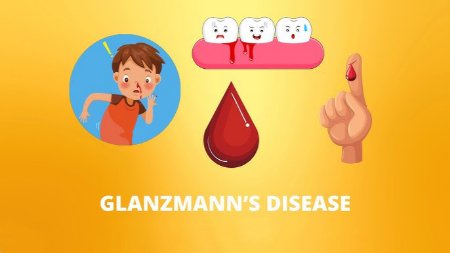 Glanzmann's thrombopathy is an inherited disease Glanzmann's disease, treatment of Glanzmann's disease