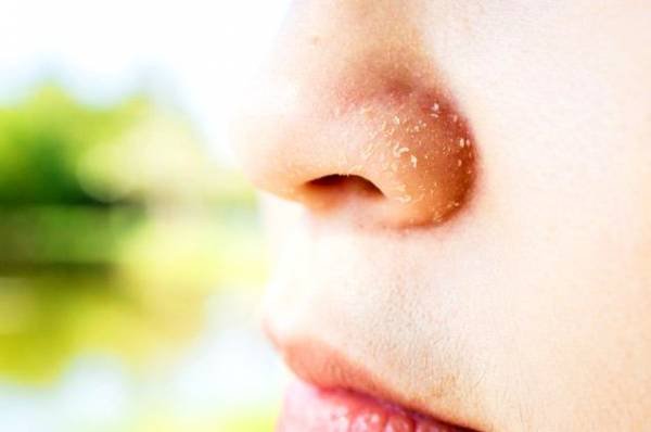 Age is a cause of peeling on the nose
