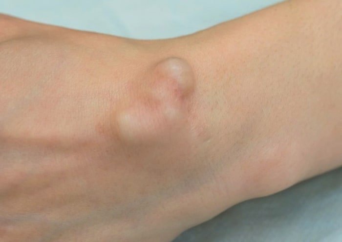 Sesame Oil for Treating Various Types of Bursitis