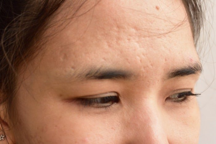 Chickenpox treatment