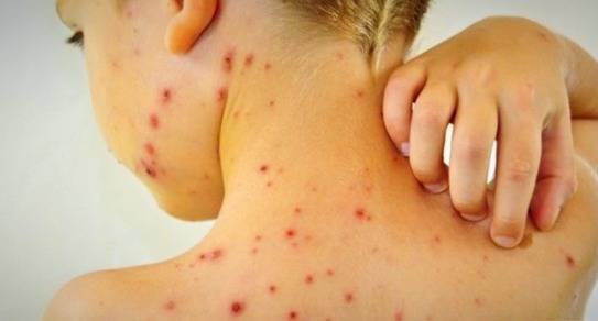 Shingles in Children Who is more likely to get shingles?