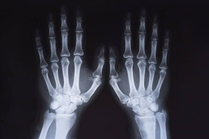 Bone scan