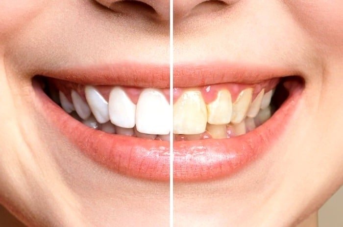 Tooth Bleaching.