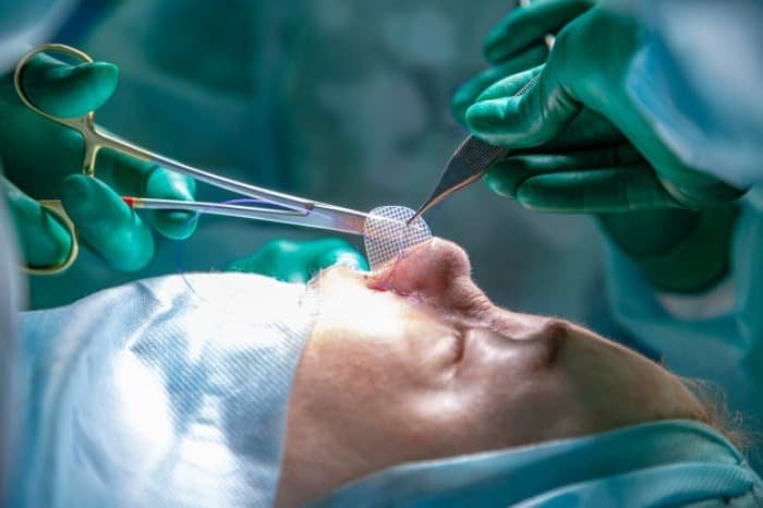 Problems with Cosmetic Nose Surgery
