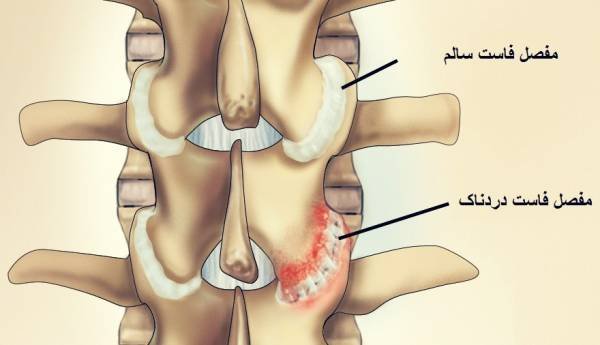 Facet joint
