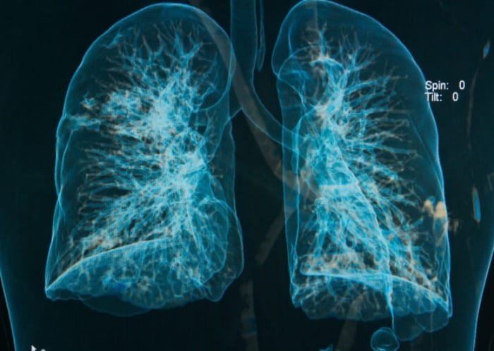 Respiratory discomfort