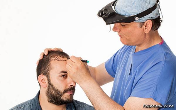 Costs of Hair Transplant Methods Hair Transplantation