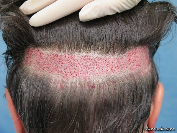 Familiarization with Different Hair Restoration and Transplant Methods Hair Restoration and Transplantation Method
