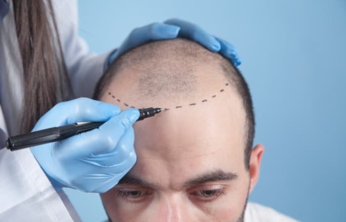 How Hair Transplant is Done