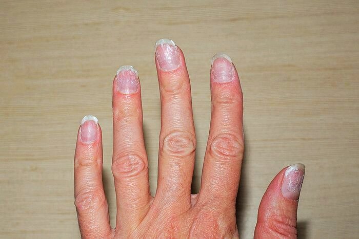 Nail fungus