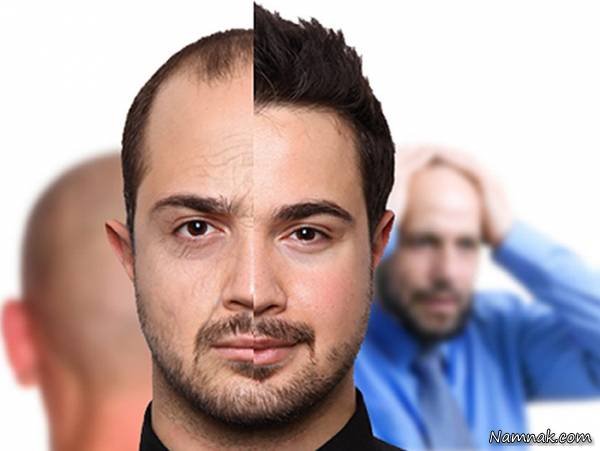 Comparison of Different Hair Transplant Methods Varieties of Hair Transplant Methods