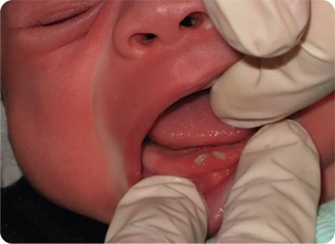 Replacement of Natal Teeth