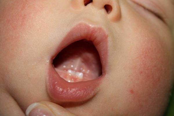 Unerupted Natal Tooth