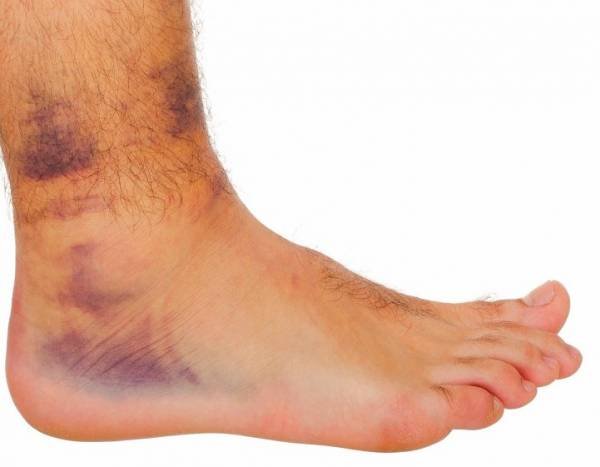 Reasons for blood clots in the leg
