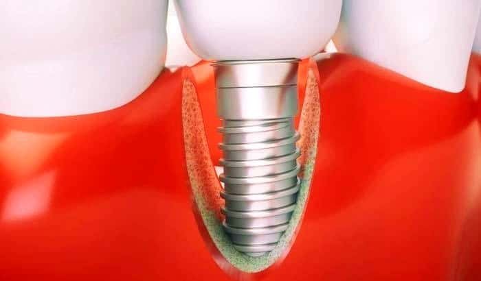Causes of Peri-implantitis