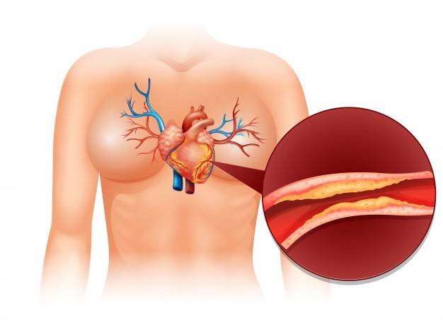 Treating cholesterol in traditional medicine