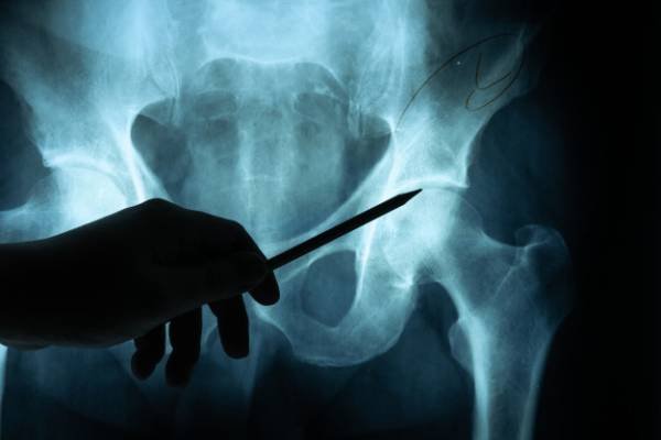 Bone Metastasis