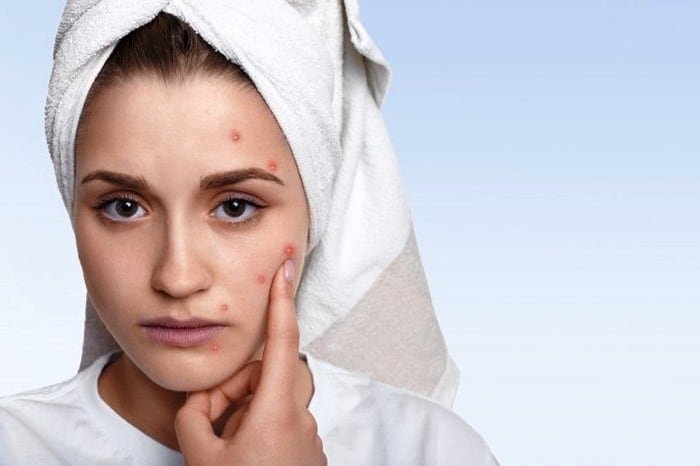 Diet and facial acne
