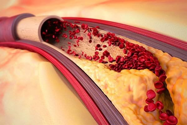 Restriction of blood flow in the vessels