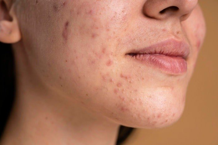 The causes of acne around the mouth.