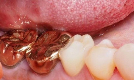 Saliva acts as a small battery in this phenomenon. Oral galvanism, burning mouth syndrome