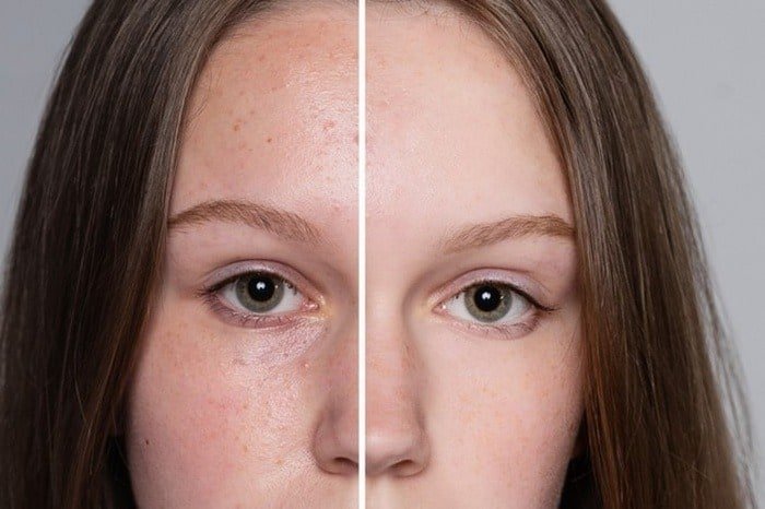 The reason for facial acne