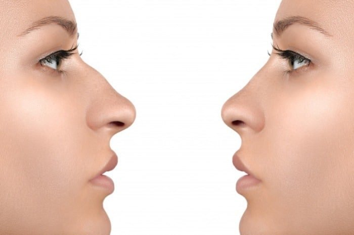 Important Points to Know Before Nose Surgery