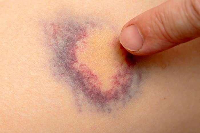 Increased bruising