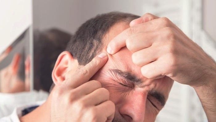 Suitable Methods for Extracting Under-Skin Pimples
