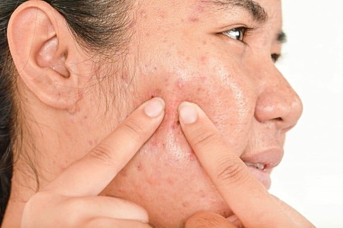 Causes of Acne on the Legs.