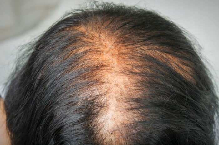 Preventing Hair Loss