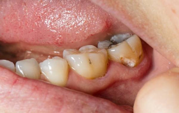Cause of Tooth Decay