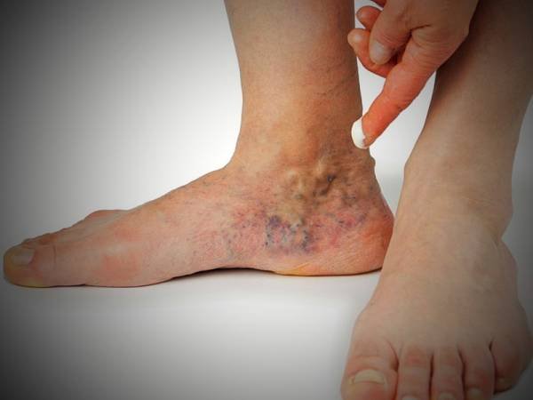 What does blood clotting in the leg indicate?
