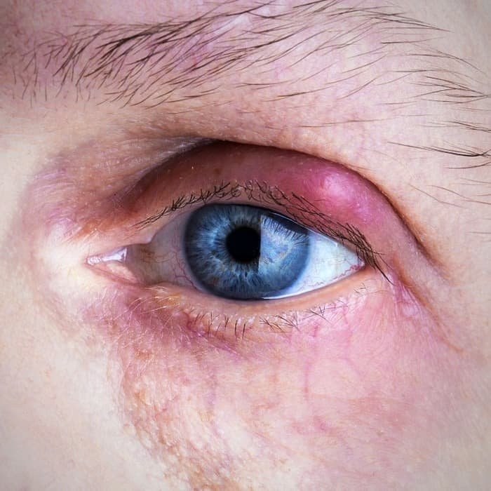 Treating styes with castor oil