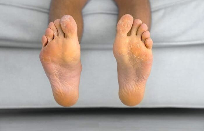Insect Bites